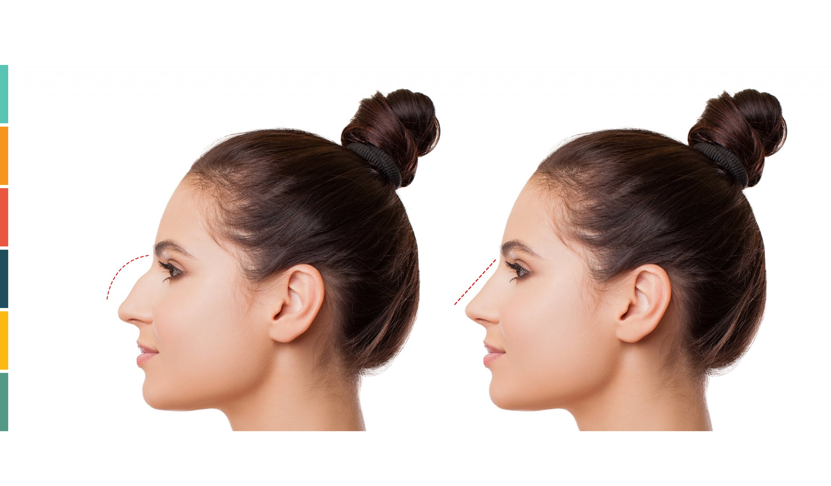 What is Rhinoplasty (nasal aesthetic surgery)?